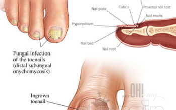 GOOD SOLUTIONS! Best natural cures for toenail fungus