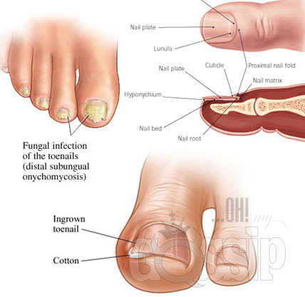 fungus